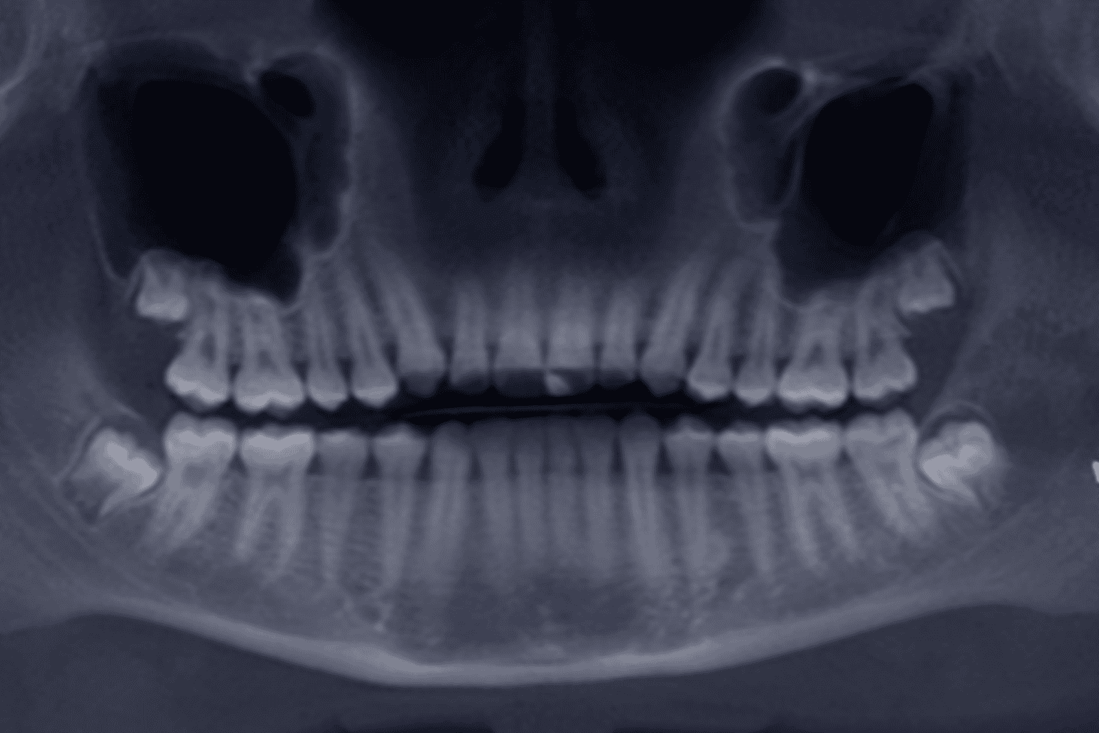 Tumores-Odontogênicos_Classificação,-Características-Clínicas-e-Importância-no-Diagnóstico-em-Odontologia