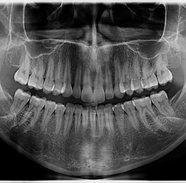 radiografia-panorâmica-odontológica